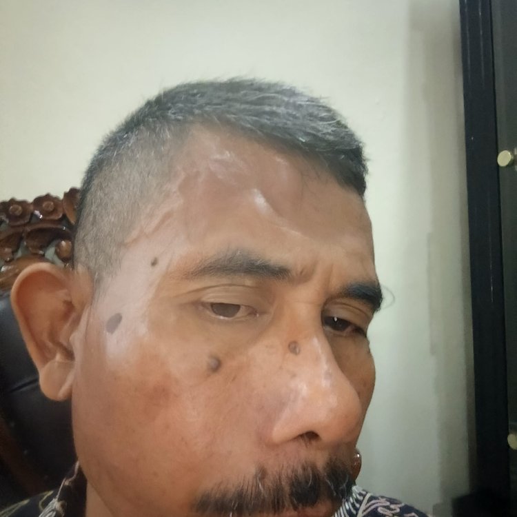 Pengeroyokan Wartawan Di Wilayah Kramatwatu Serang Banten Diduga Akibat Penelusuran Miras Ilegal 